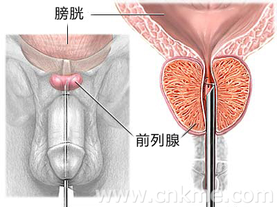 手淫引起的前列腺炎怎么办